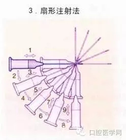 即使是老手也會(huì)失手的麻醉----下牙槽、舌、頰一次阻滯麻醉