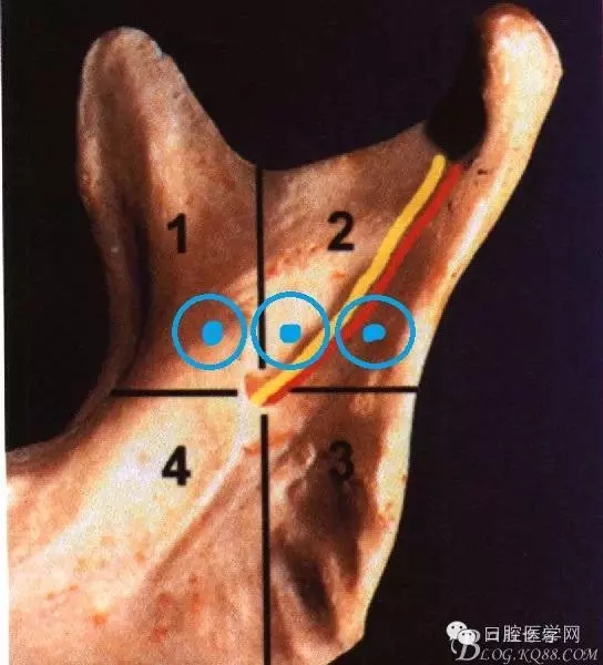即使是老手也會(huì)失手的麻醉----下牙槽、舌、頰一次阻滯麻醉