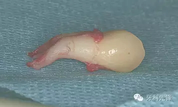 拔牙斷根了怎么辦？