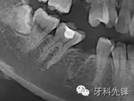 拔牙斷根了怎么辦？