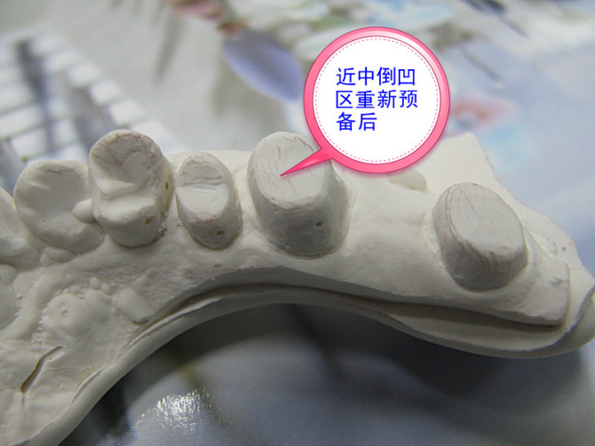口腔修復醫生備牙取摸常見問題系列之——基牙倒凹 與 備牙時“就位道”的處理