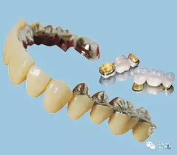 為何烤瓷牙的價格從幾百元至數(shù)千元不等？告訴您11種烤瓷牙的特點、價格及優(yōu)缺點