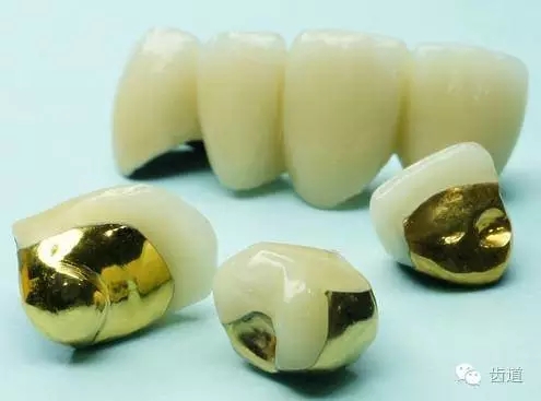 為何烤瓷牙的價格從幾百元至數(shù)千元不等？告訴您11種烤瓷牙的特點、價格及優(yōu)缺點