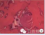 頜骨良性成牙骨質(zhì)細胞瘤