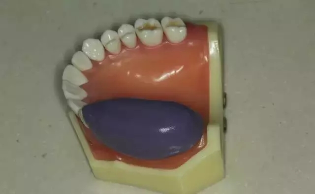 硅橡膠導板——牙體預備步驟詳解