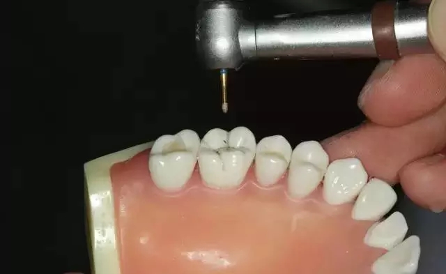 硅橡膠導板——牙體預備步驟詳解
