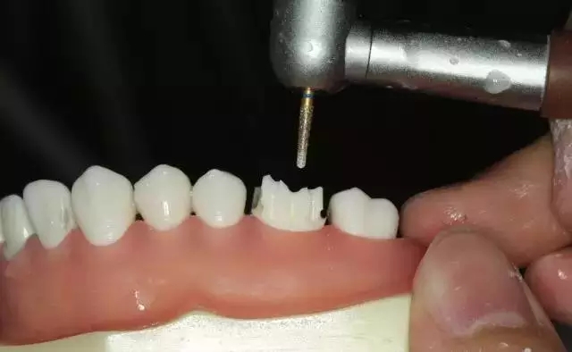 硅橡膠導板——牙體預備步驟詳解