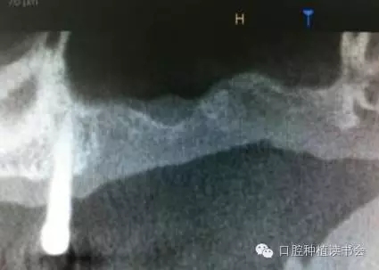 上頜后牙區種植治療的關鍵技術之—上頜竇提升術