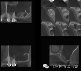 上頜后牙區種植治療的關鍵技術之—上頜竇提升術