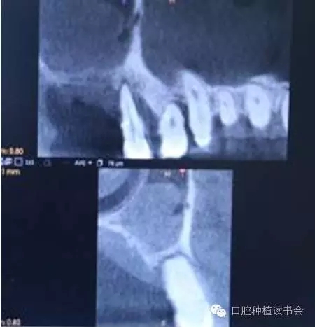 上頜后牙區種植治療的關鍵技術之—上頜竇提升術