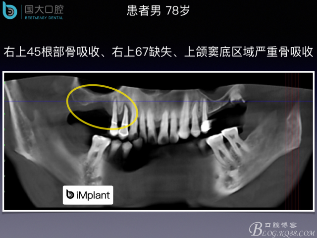 上頜竇底區域嚴重骨吸收的臨床種植案例.jpeg