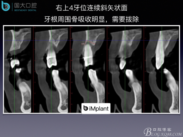 上頜竇底區域嚴重骨吸收的臨床種植案例.jpeg