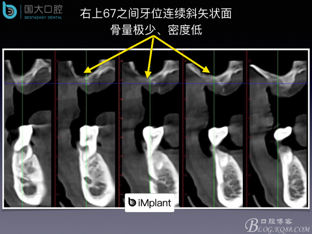 上頜竇底區域嚴重骨吸收的臨床種植案例.jpeg