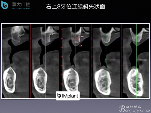 上頜竇底區域嚴重骨吸收的臨床種植案例.jpeg