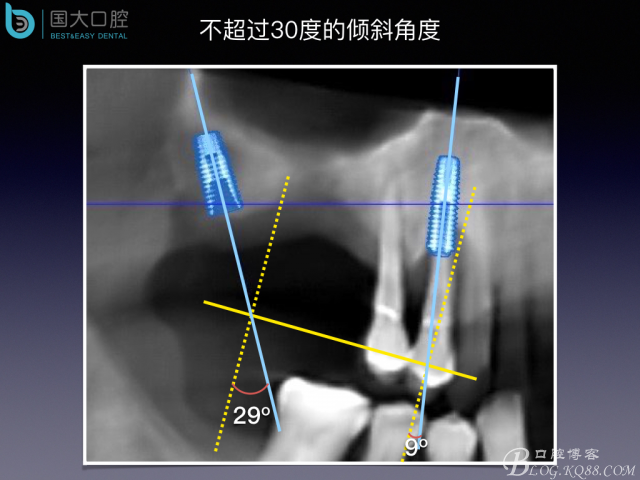 上頜竇底區域嚴重骨吸收的臨床種植案例.jpeg