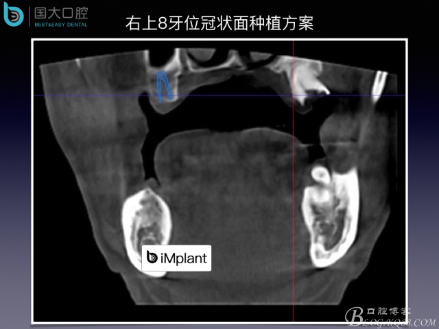 上頜竇底區域嚴重骨吸收的臨床種植案例.jpeg