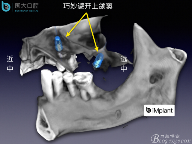 上頜竇底區域嚴重骨吸收的臨床種植案例.jpeg
