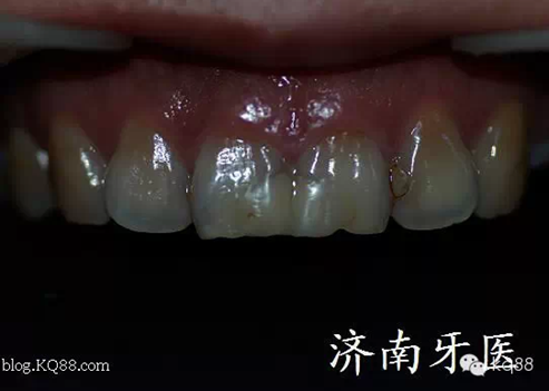 四環素牙修復真實操作.png