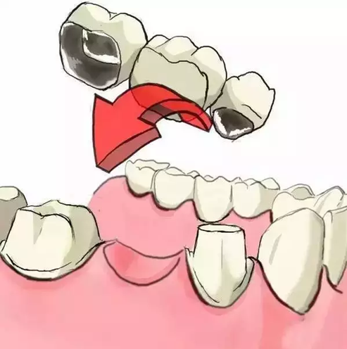 圖解：種牙與鑲牙的區別，缺牙的趕緊看.png