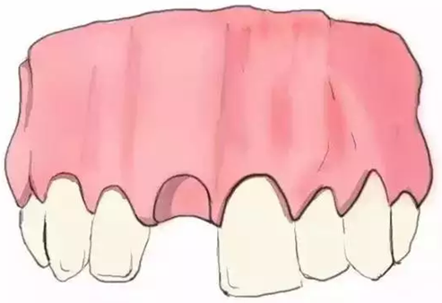 圖解：種牙與鑲牙的區別，缺牙的趕緊看.png