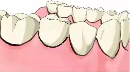 圖解：種牙與鑲牙的區別，缺牙的趕緊看.png