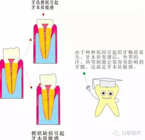 【愛牙科普知識(shí)300問】 “什么是牙本質(zhì)敏感？”