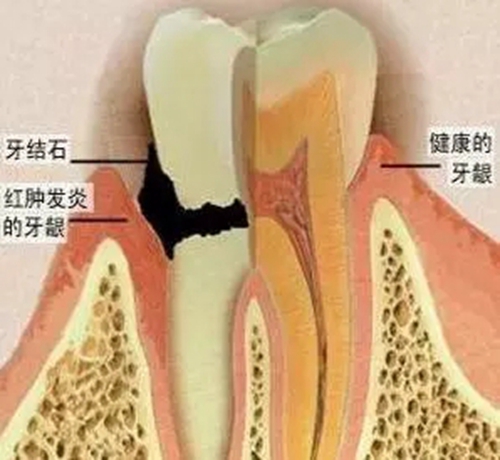 【愛牙科普】口腔謠言終結(jié)者——每天刷牙，洗牙該不該？！