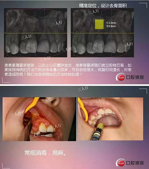 深部埋伏多生牙——微創處理  