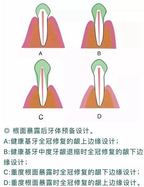 做全冠修復時基牙根面暴露，如何備牙？