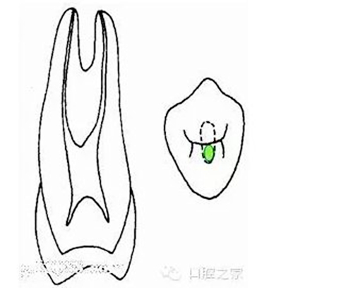 根管治療之根管口的探查要點  