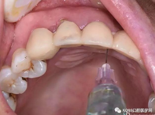上頜側切牙根尖手術——張東星  
