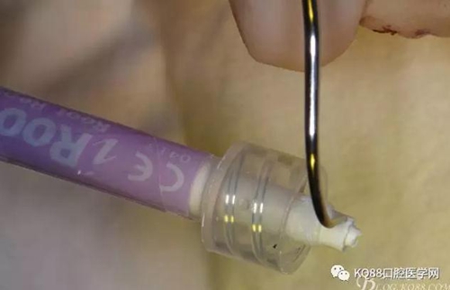 上頜側切牙根尖手術——張東星  