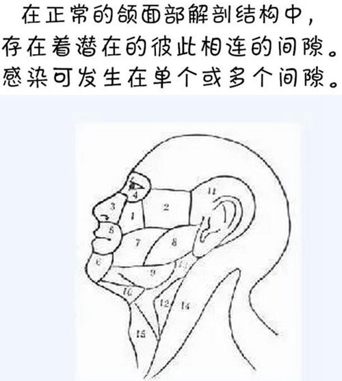 警惕！牙疼引發的間隙感染很危險