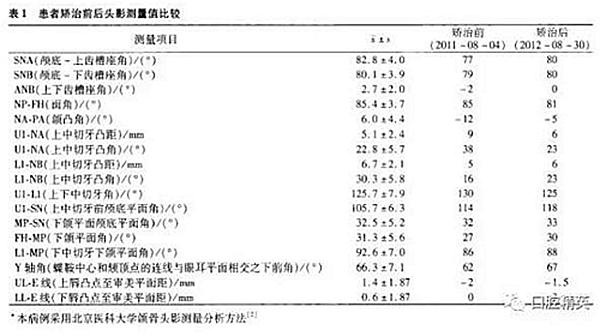 尖牙完全唇側錯位擁擠，矯正1例  