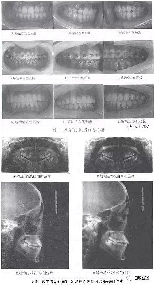 尖牙完全唇側錯位擁擠，矯正1例  