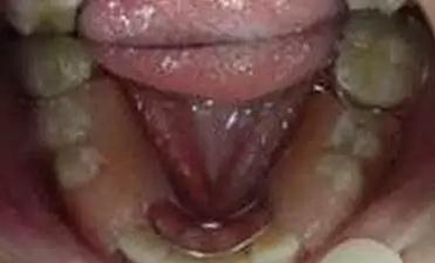 間隙保持器的應用