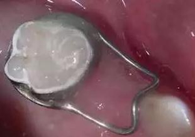 間隙保持器的應用