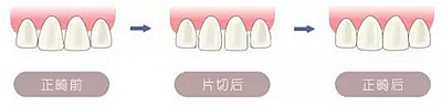 醫(yī)生方案里的鄰面去釉，究竟是什么？