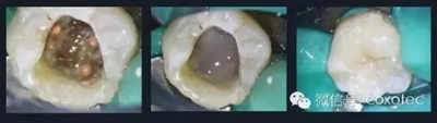 【現代根管治療】之熱牙膠充填技術