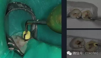 【現代根管治療】之熱牙膠充填技術
