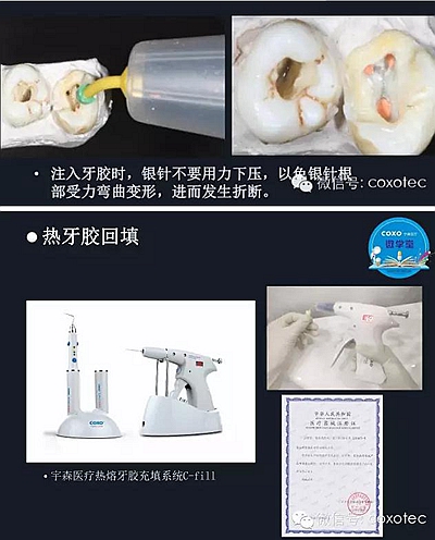 【現代根管治療】之熱牙膠充填技術