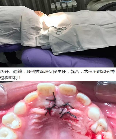 多生牙的拔除總原則：早發現，早處理！