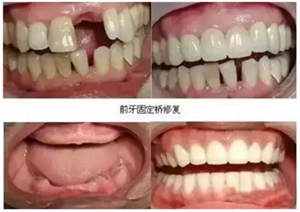 一位資深牙醫的總結 | 如何減輕患者鑲牙后酸痛癥狀的措施！