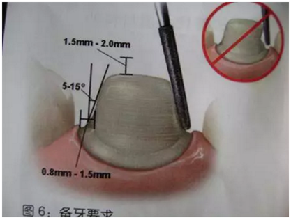 醫生，我的烤瓷牙上有個黑線怎么回事？