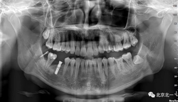 多學科病例分析---正畸、種植、微創(chuàng)拔牙多學科交叉病例
