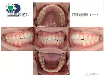 多學科病例分析---正畸、種植、微創(chuàng)拔牙多學科交叉病例