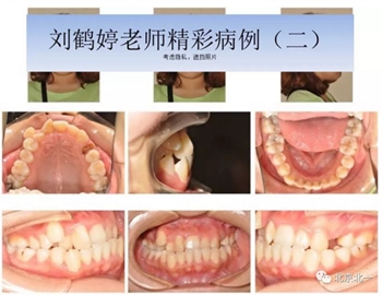 多學科病例分析---正畸、種植、微創(chuàng)拔牙多學科交叉病例