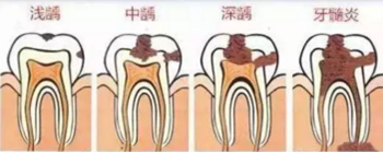 當心“腹黑”齲齒，牙齒有個小洞也要補！