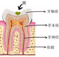 當心“腹黑”齲齒，牙齒有個小洞也要補！