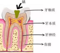 當心“腹黑”齲齒，牙齒有個小洞也要補！